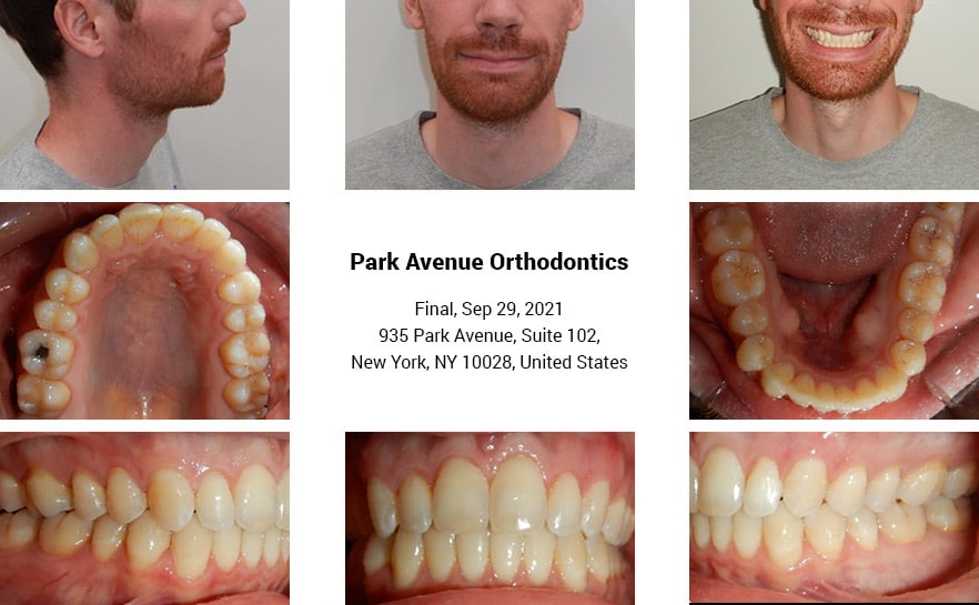 Straighten Your Teeth Effortlessly with OrthoSnap in New York City