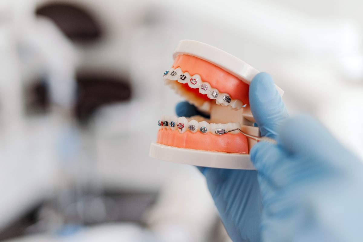 Ideal Age for Braces: When to Start Orthodontic Treatment